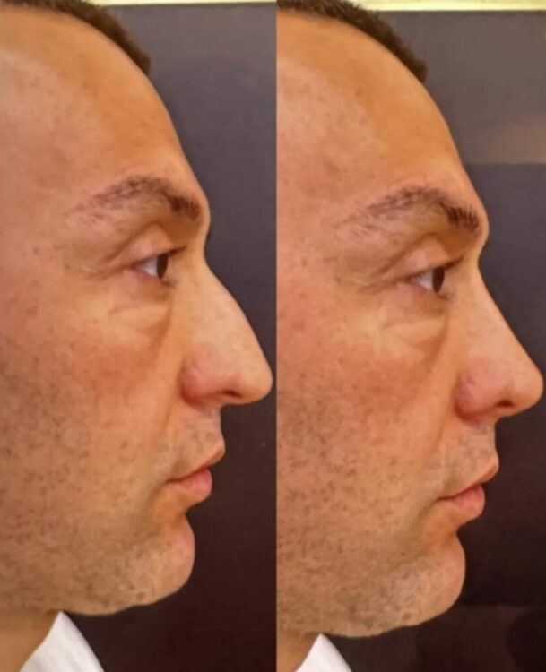 NUK DO TA njihni... G-Bani i nënshtrohet një tjetër ndërhyrjeje në fytyrë